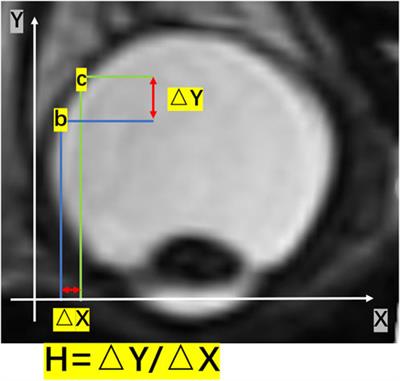 Analysis of morphological and quantitative changes in pathological myopia and perioperative changes in posterior scleral reinforcement using three-dimensional magnet resonance imaging